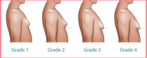 Comparison of different gynecomastia grades with Grade 3 characteristics