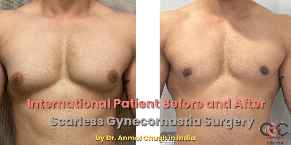 International patient before and after scarless gynecomastia surgery by Dr. Anmol Chugh in India