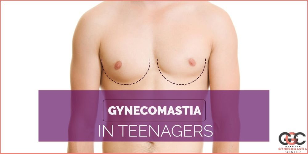Teenage boy feeling self-conscious about chest due to gynecomastia