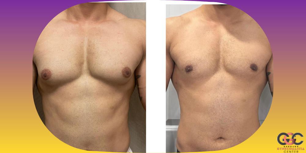 Natural male chest contours after gynecomastia surgery – realistic, masculine results