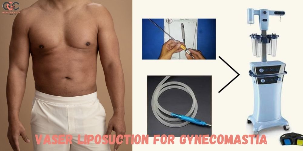 VASER Liposuction for Gynecomastia