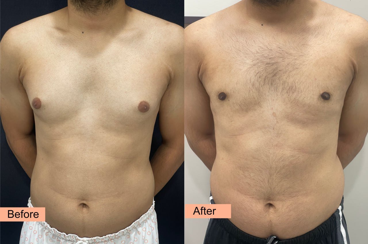 30-year-old male, 3 months postop gynecomastia