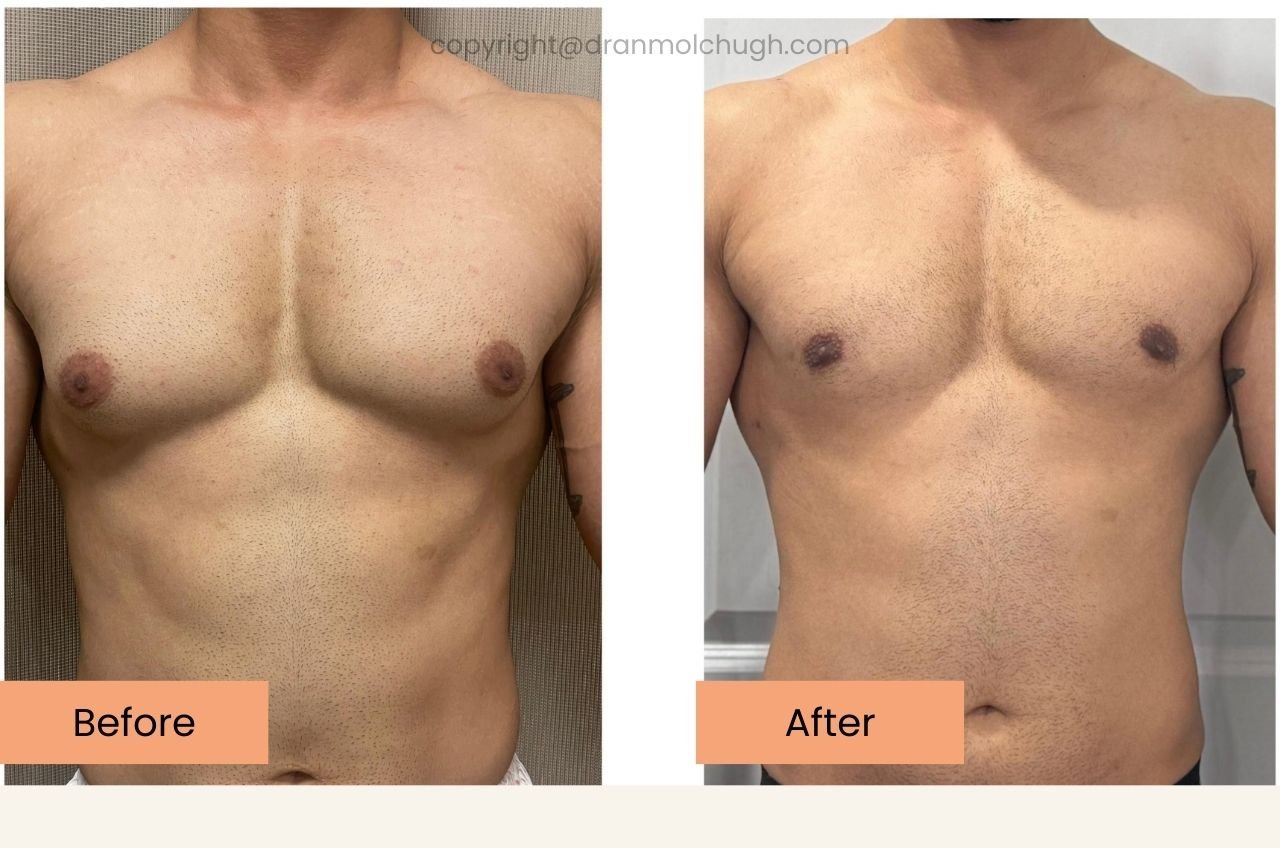 Gynecomastia surgery results 36 year old bodybuilder
