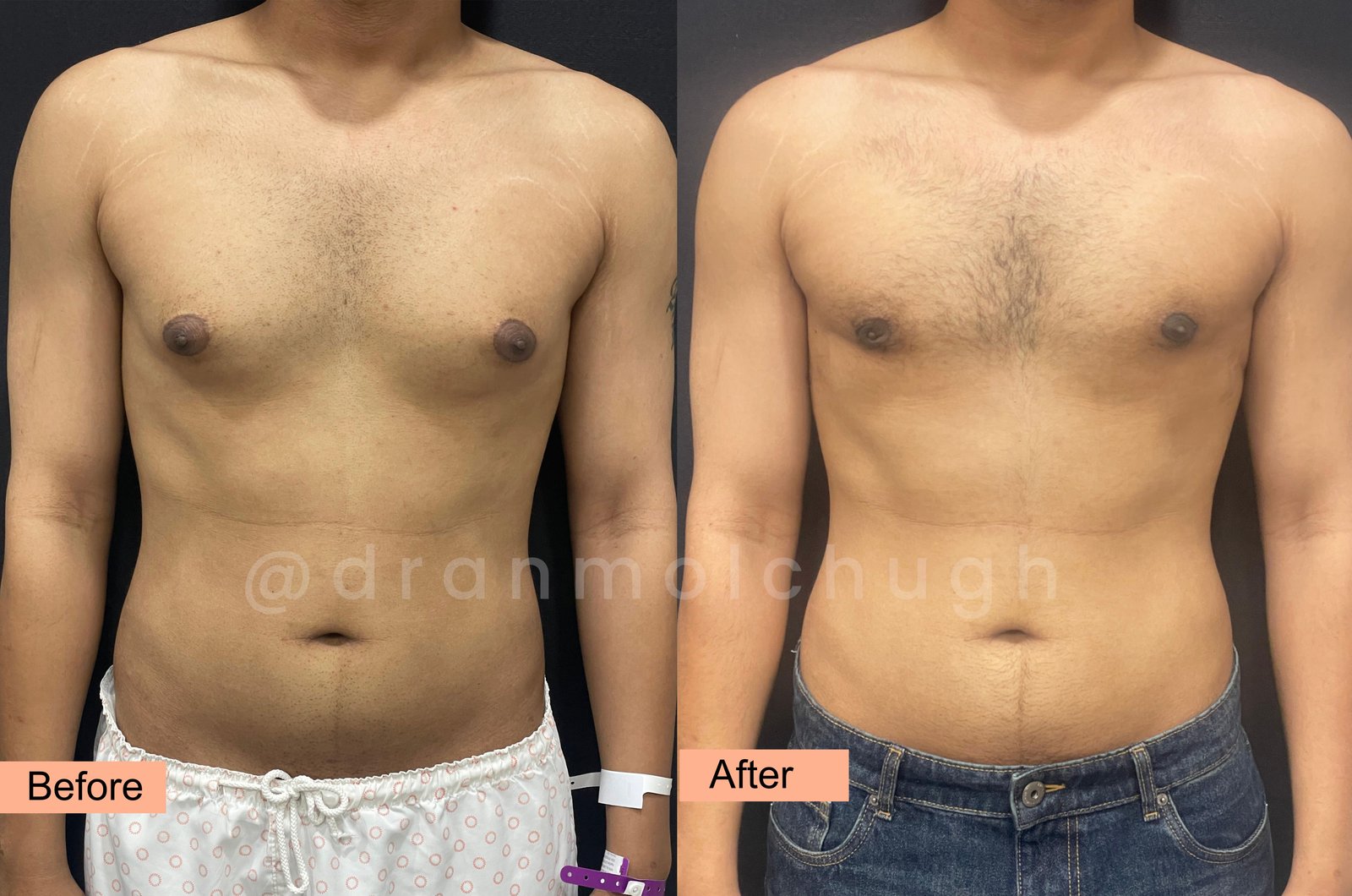 Grade 4 Gynecomastia Before and After Results